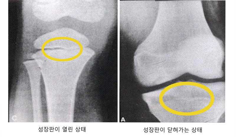 성장판비교그림.jpg