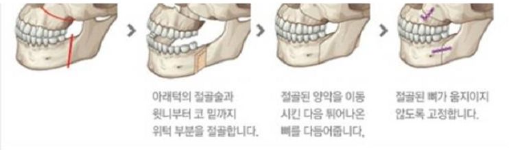 양악수술1.jpg