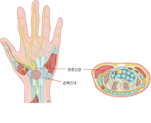 손목터널증후군_100.jpg