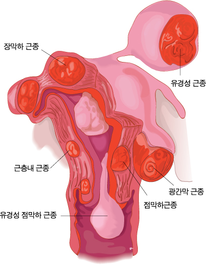 자궁경부암1_3321 - 복사본.jpg