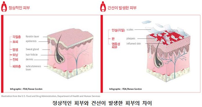 정상적인 피부와 건선이.jpg