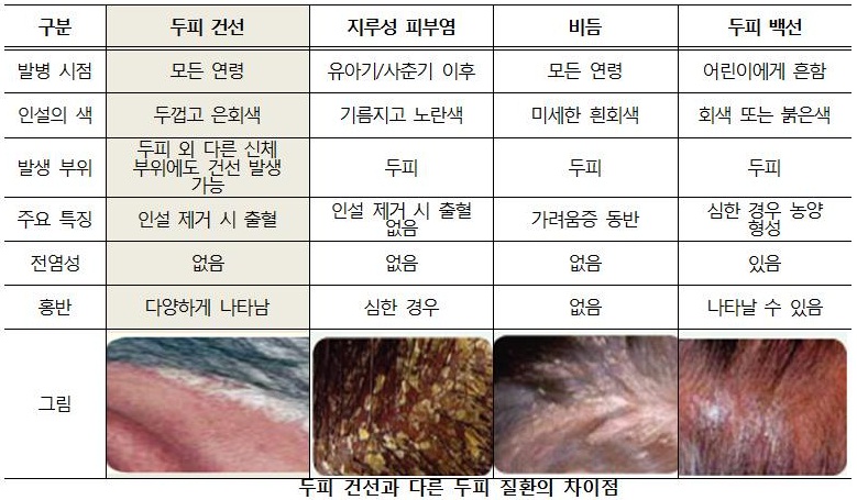 두피건선과 다른두피질환의 차이점.jpg