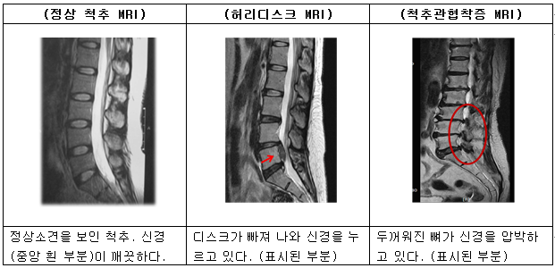 척추관협착증 표.png